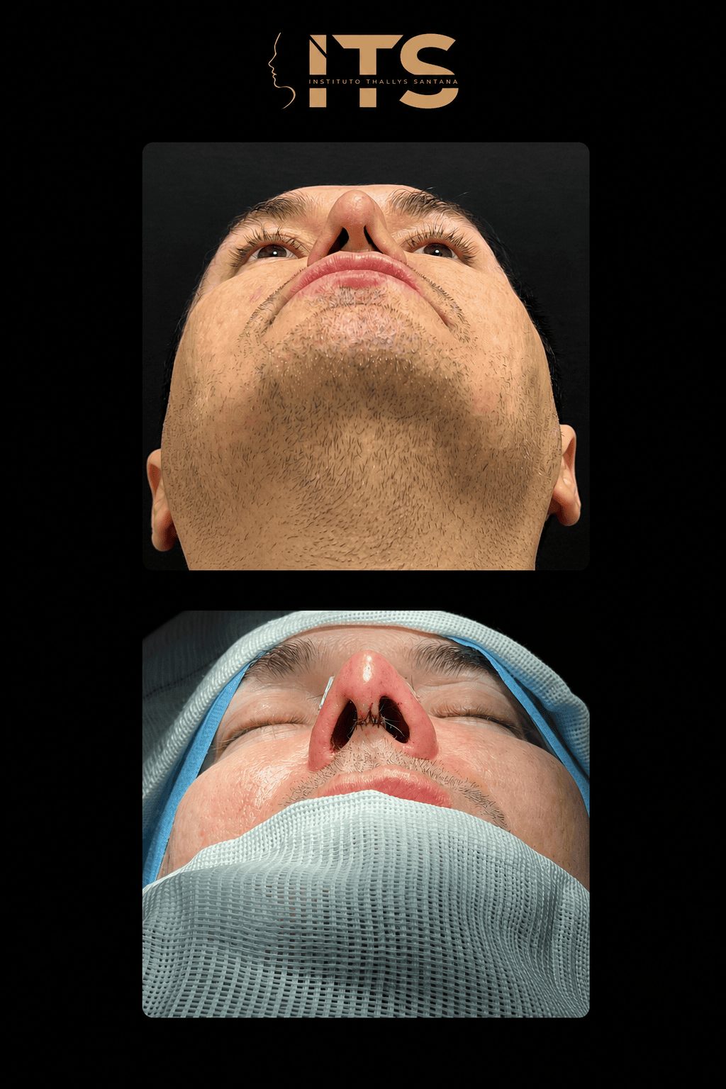 Antes (acima) e depois (abaixo) de rinoplastia em vista basal, mostrando simetria das narinas