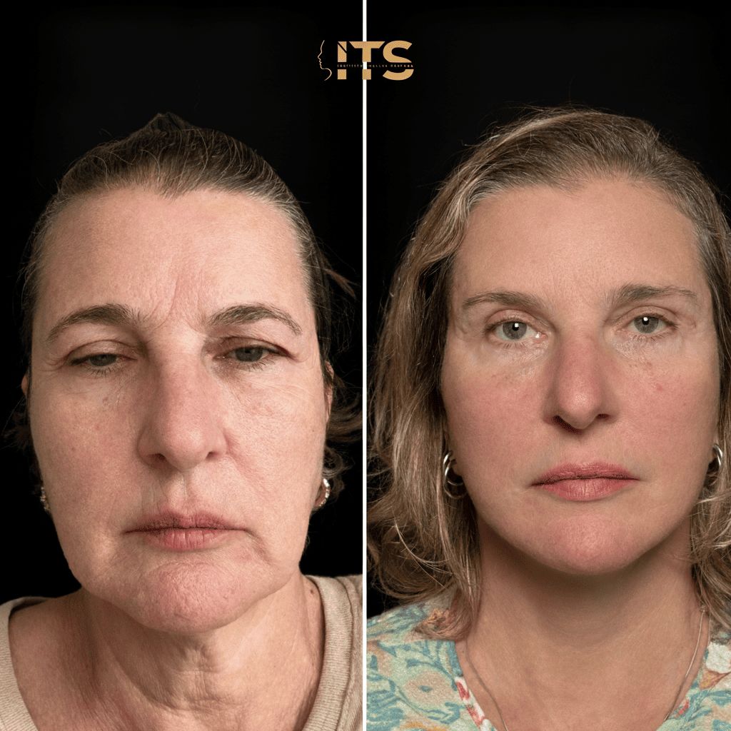 Antes e depois de lifting facial em paciente feminina, com melhora da flacidez de face e pescoço
