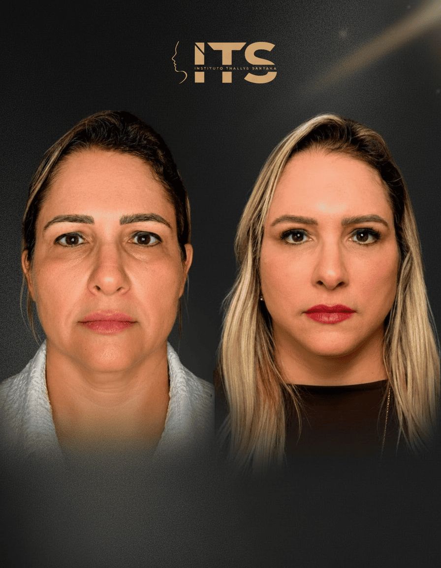 Antes e depois de lifting facial em paciente feminina, com melhora da flacidez do terço médio da face