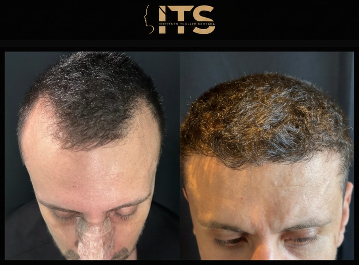 Antes e depois de transplante capilar: topo da cabeça com rarefação e densidade recuperada após o procedimento