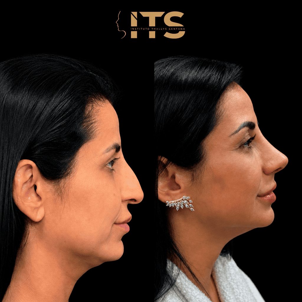 Antes e depois de rinoplastia em paciente feminina, vista de perfil, com perfil nasal mais equilibrado