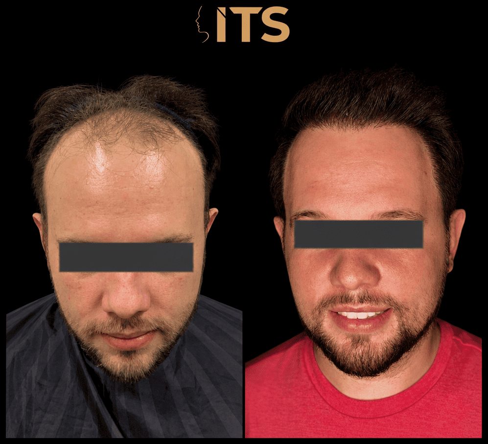 Antes e depois de transplante capilar com reconstrução da linha frontal em vista de frente