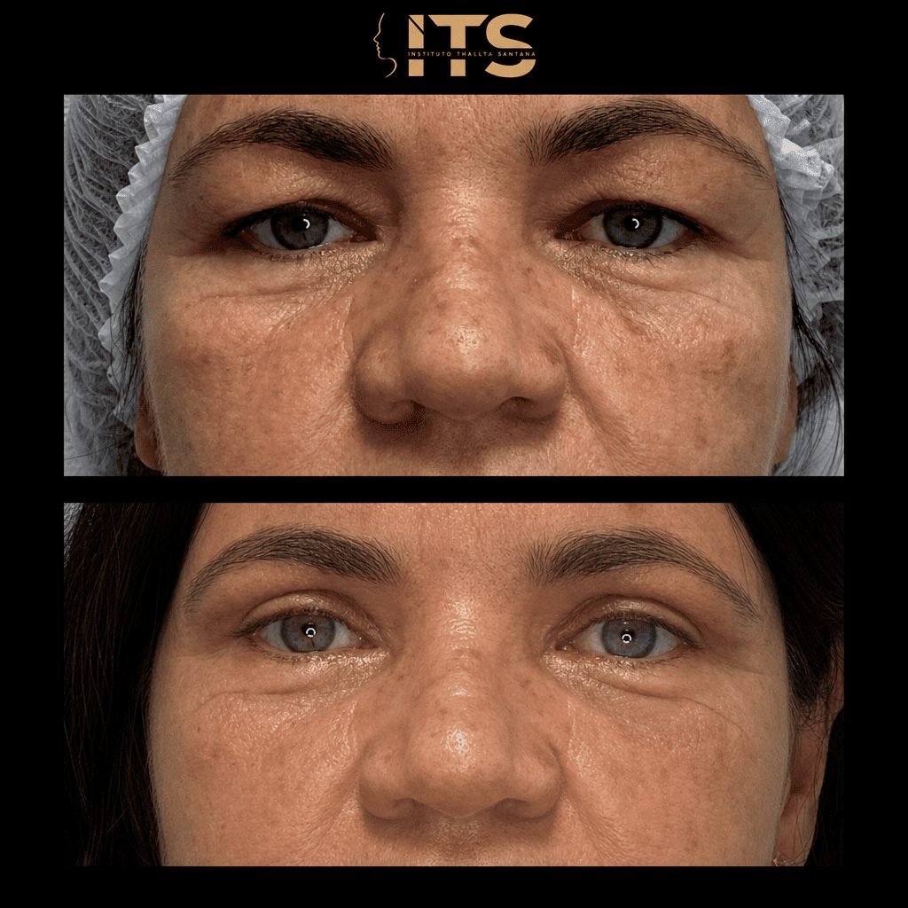 Antes e depois de blefaroplastia com correção da flacidez das pálpebras superiores e olhar mais definido