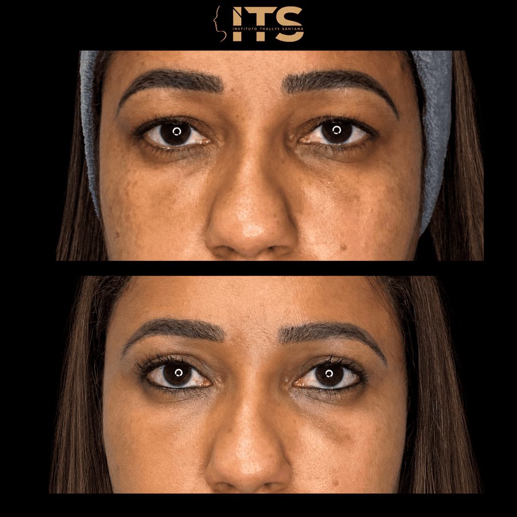 Antes e depois de blefaroplastia em paciente jovem, com pálpebras inferiores mais lisas e olhar mais aberto