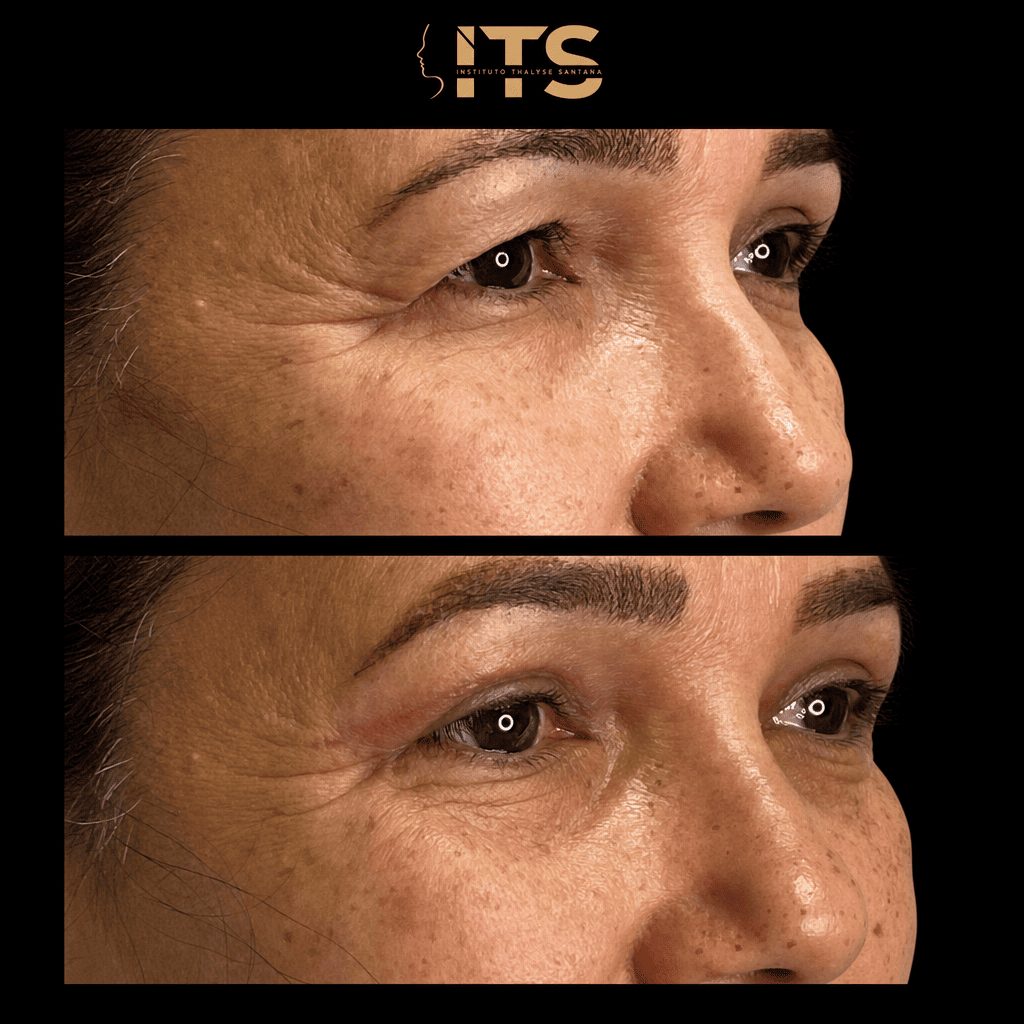 Antes e depois de blefaroplastia em vista lateral, mostrando o contorno da pálpebra e da região periorbital