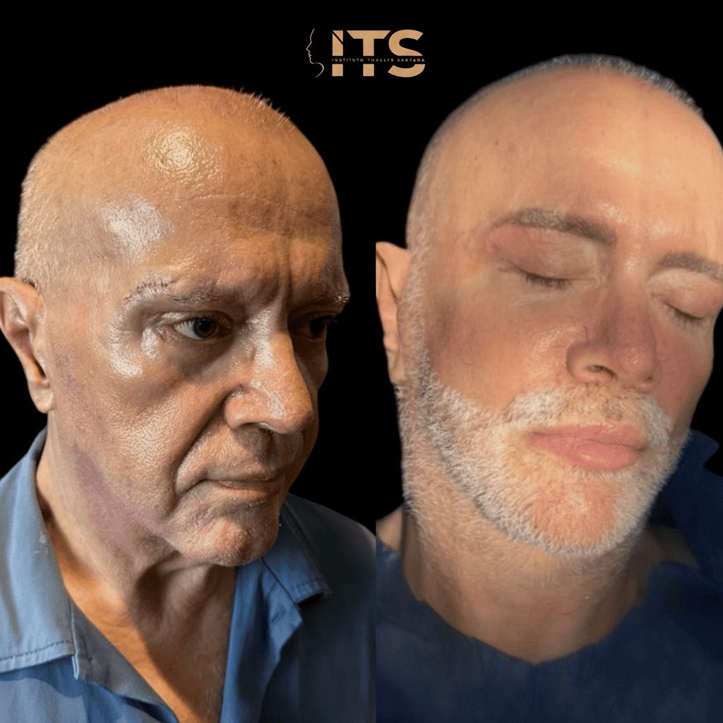 Antes e depois de lifting facial em paciente masculino idoso, com suavização de sulcos e flacidez