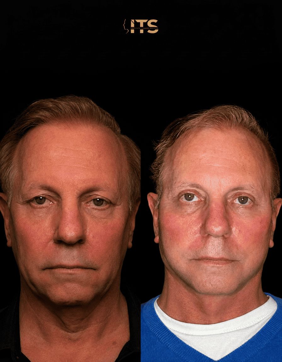 Antes e depois de lifting facial em paciente masculino, com reposicionamento dos tecidos da face