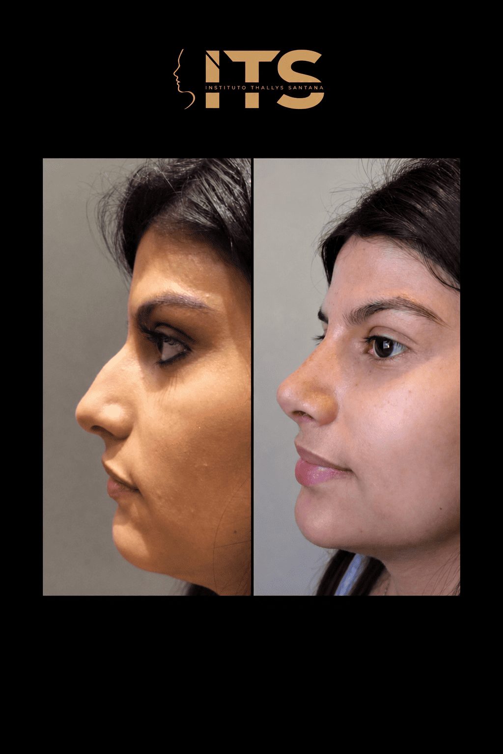 Antes e depois de rinoplastia em paciente feminina, vista de perfil, com correção da giba nasal