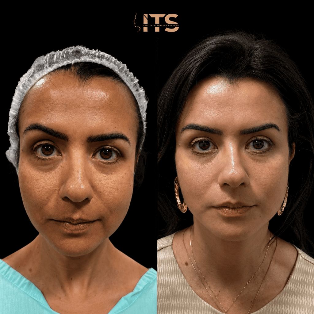 Antes e depois de lifting facial em paciente feminina, vista frontal, com aspecto mais descansado