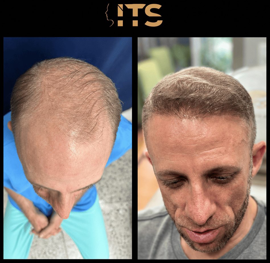 Antes e depois de transplante capilar em calvície do topo da cabeça, com cobertura da coroa