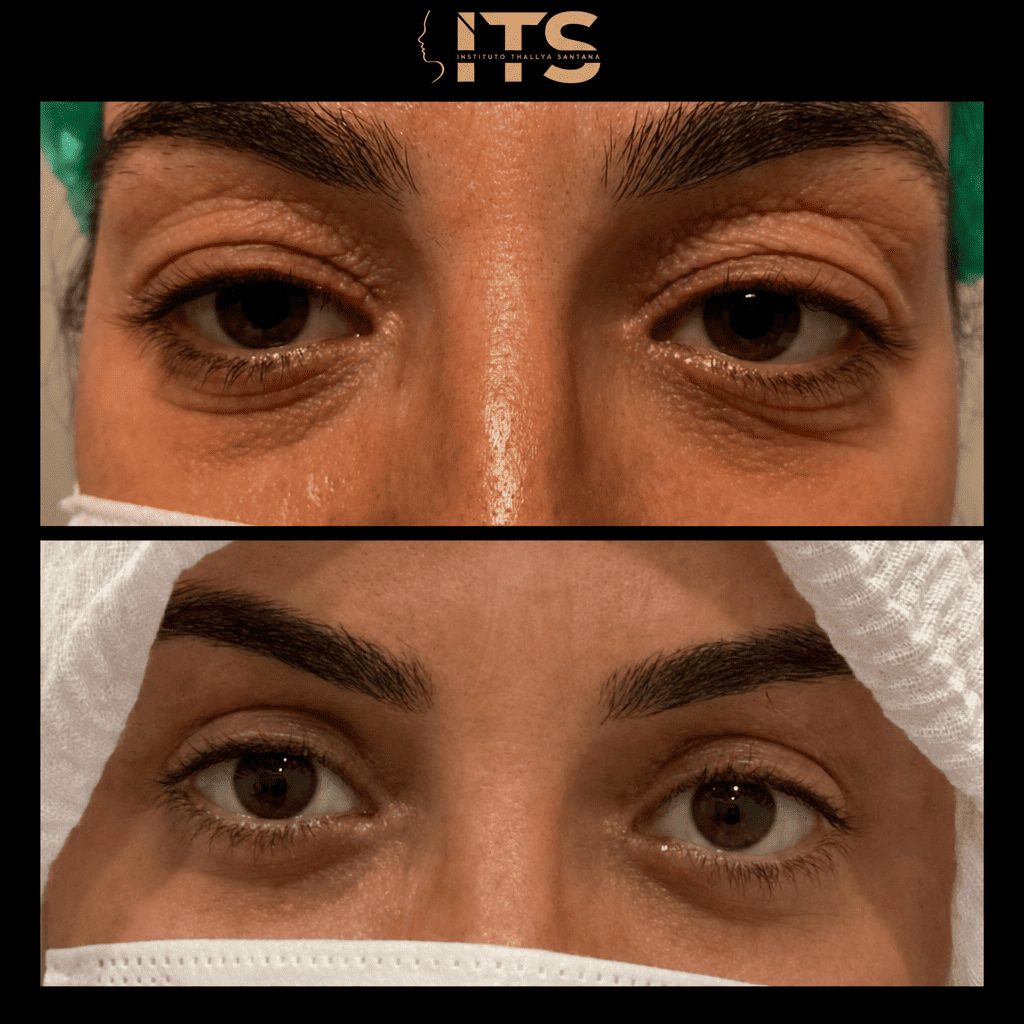 Antes e depois de blefaroplastia inferior com redução das bolsas de gordura sob os olhos