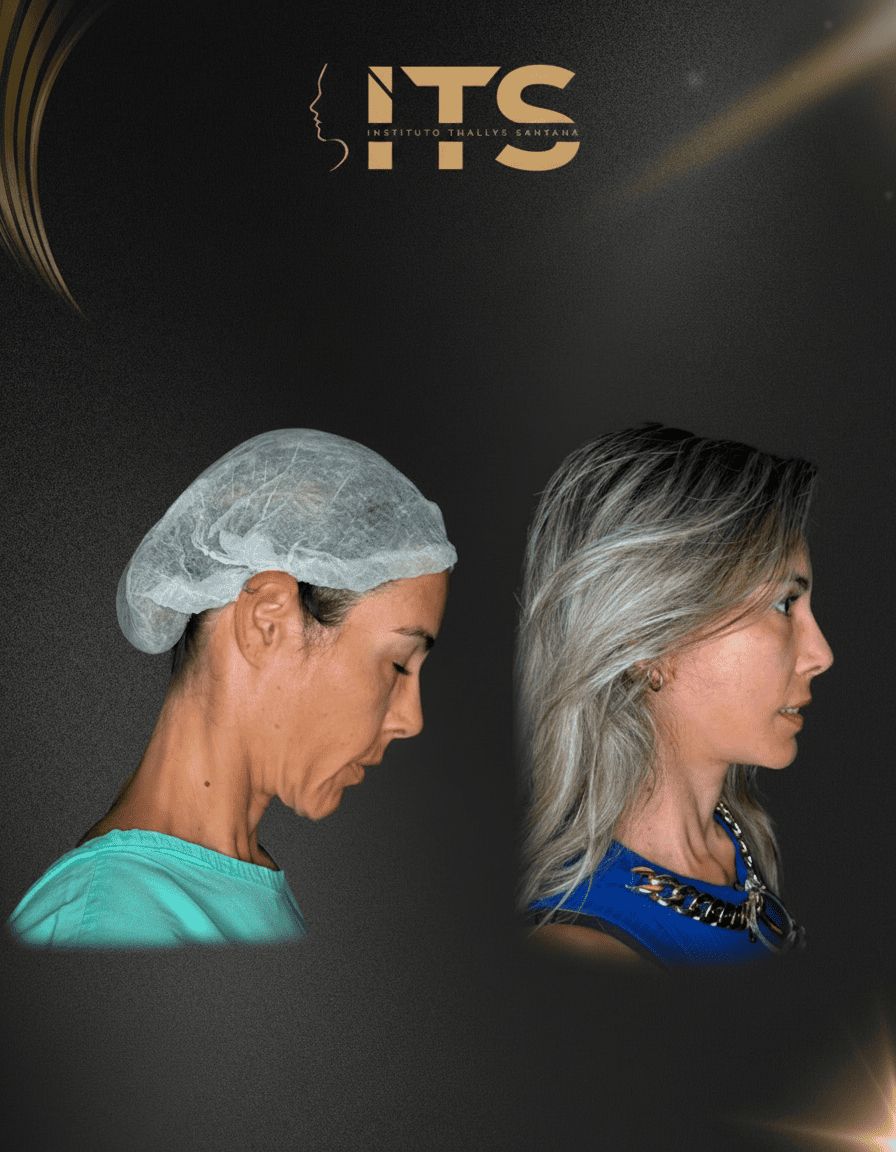 Antes e depois de lifting facial e cervical em vista de perfil, com contorno do pescoço mais definido