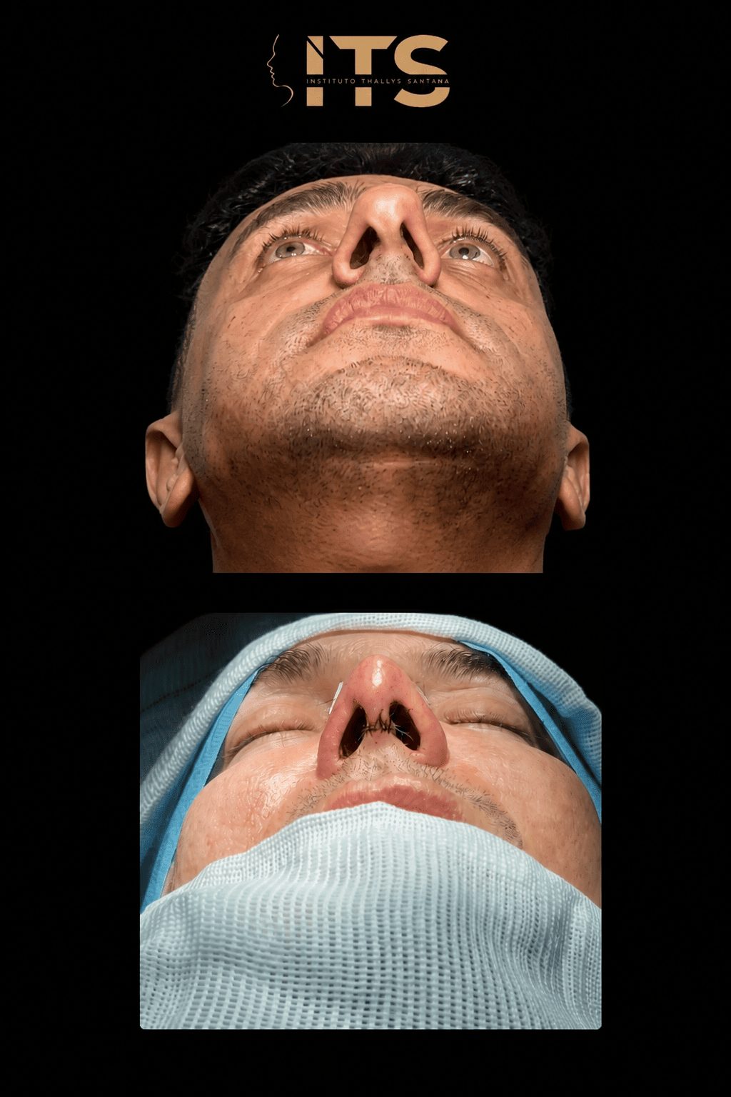 Antes (acima) e depois (abaixo) de rinoplastia em vista basal, com projeção e simetria da ponta nasal
