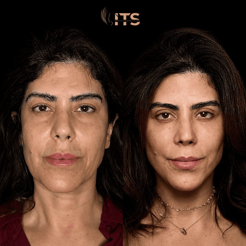Antes e depois de lifting facial em paciente feminina, vista frontal, com pele mais firme e contorno facial rejuvenescido