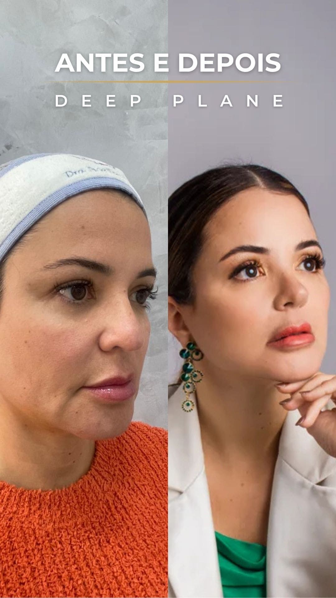 Antes e depois de lifting facial deep plane em vista de perfil, com definição do contorno mandibular