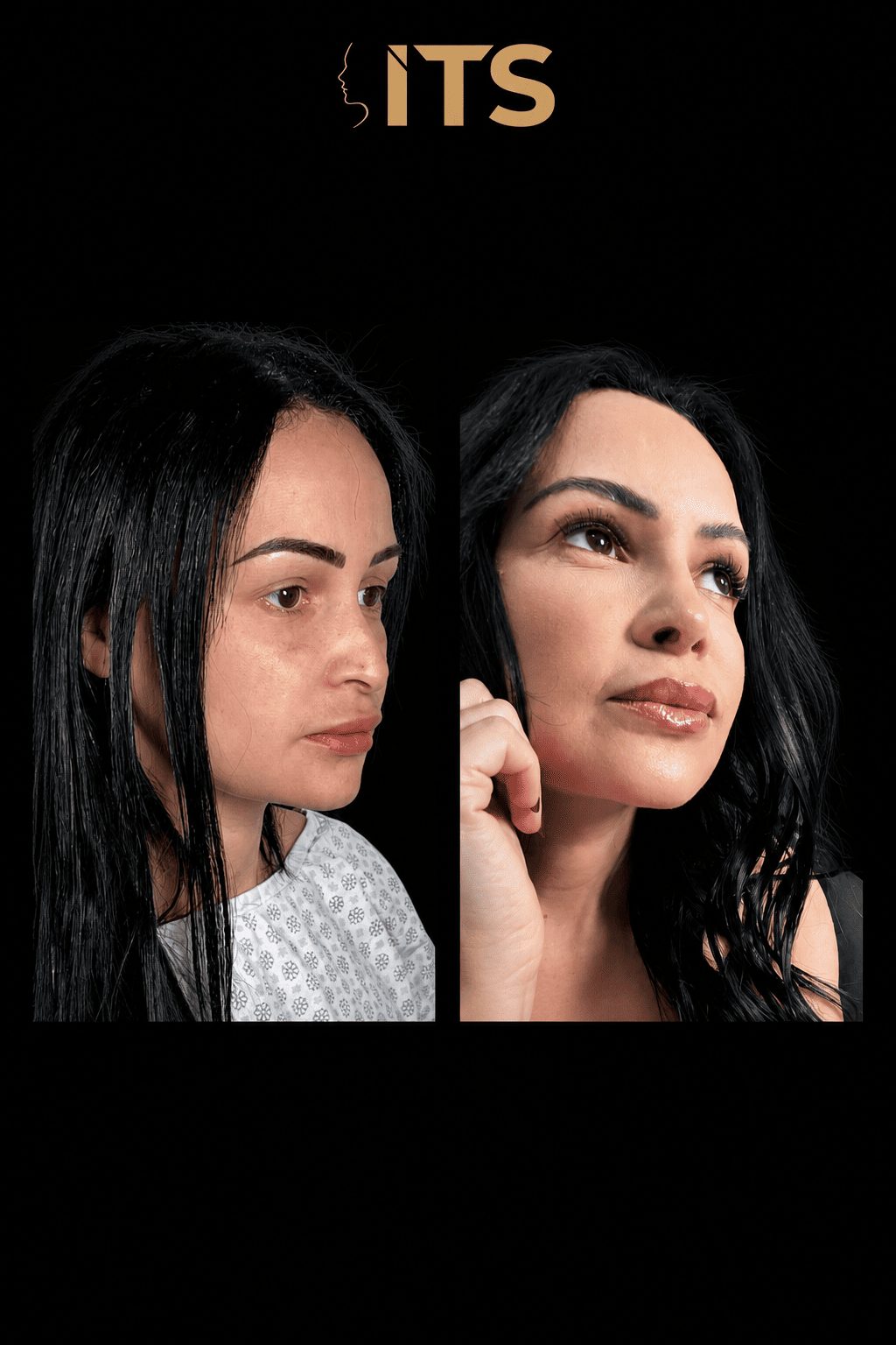 Antes e depois de rinoplastia em paciente feminina, vista de três quartos, com nariz mais definido