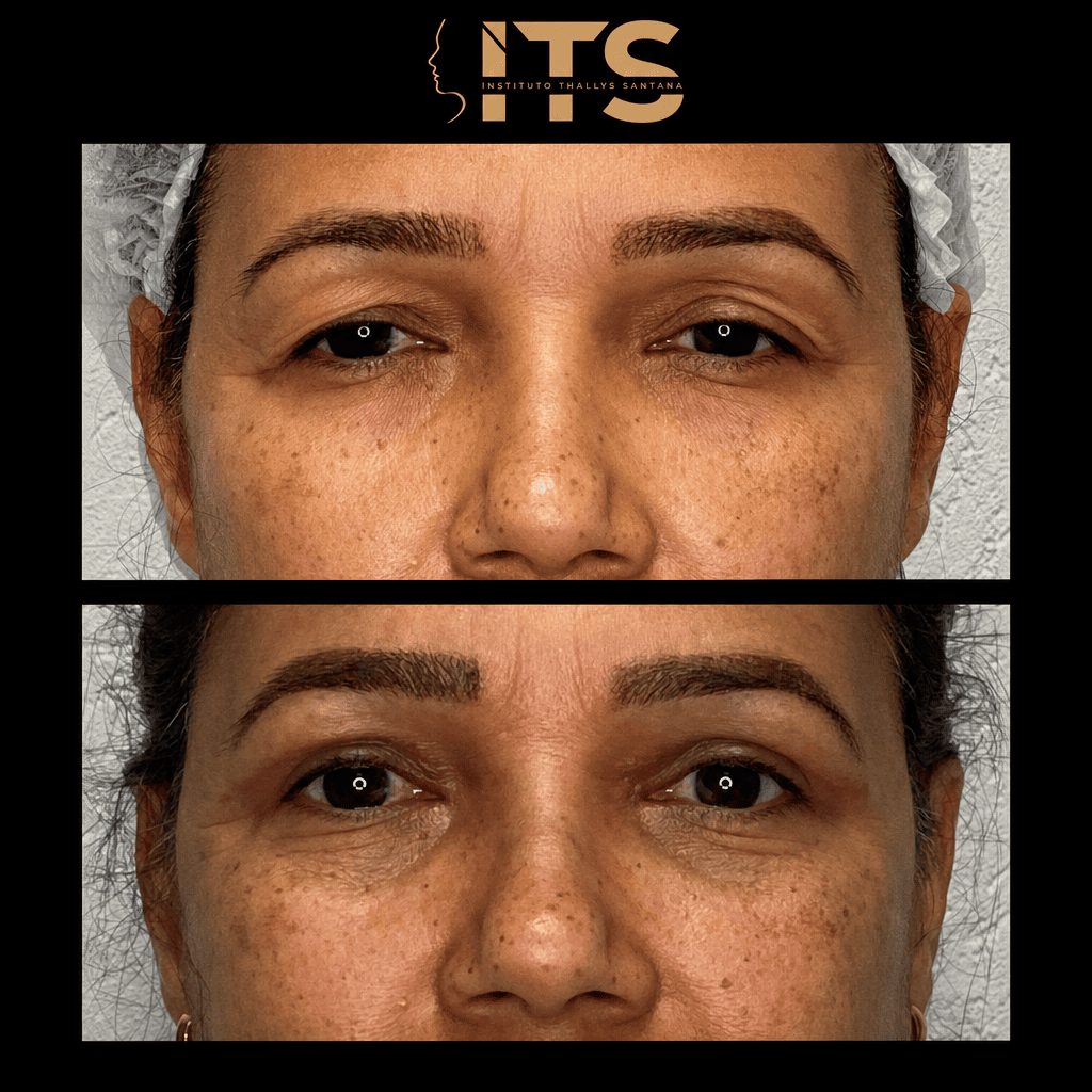 Antes e depois de blefaroplastia superior e inferior: pálpebras com excesso de pele acima e olhar mais aberto após a cirurgia
