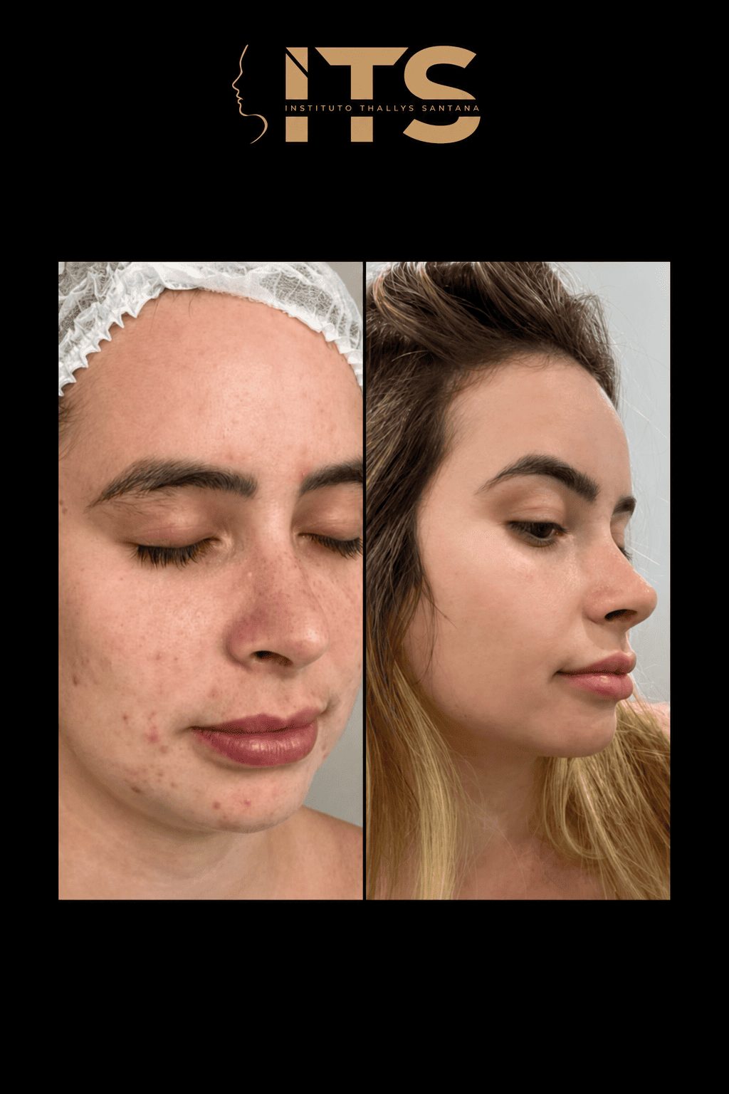 Antes e depois de rinoplastia em paciente feminina, vista de três quartos, com nariz mais harmônico ao rosto
