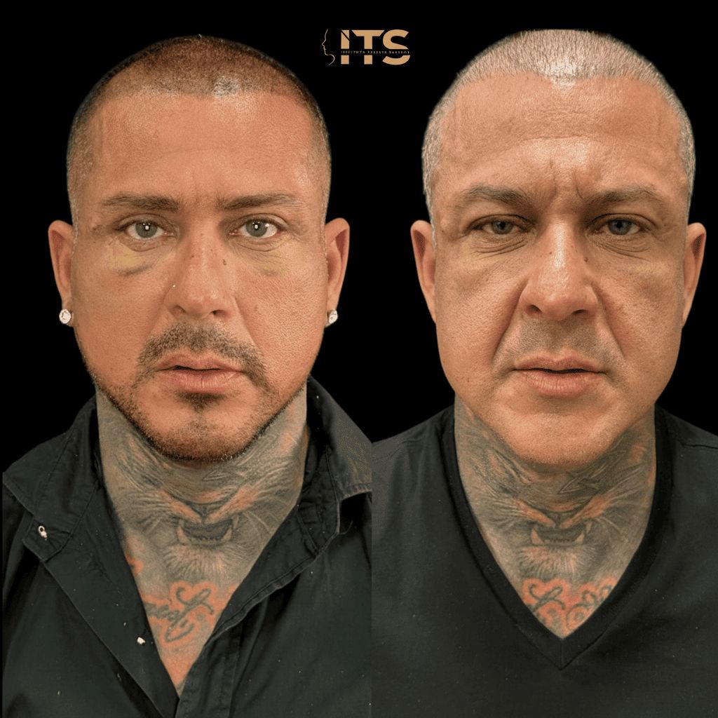 Antes e depois de lifting facial em paciente masculino, vista frontal, com contorno mais definido