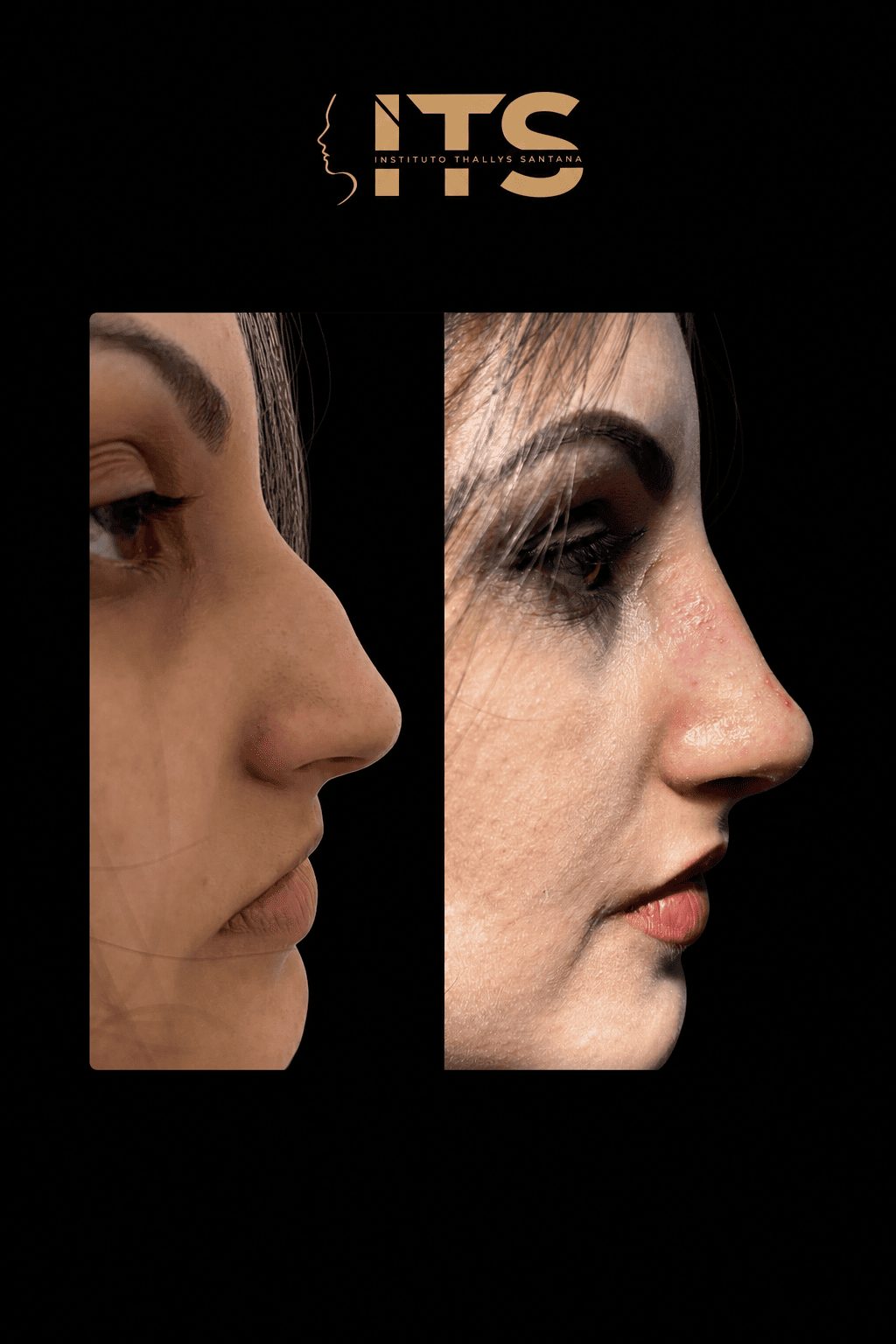 Antes e depois de rinoplastia em paciente feminina, vista de perfil, com refinamento do dorso e da ponta nasal