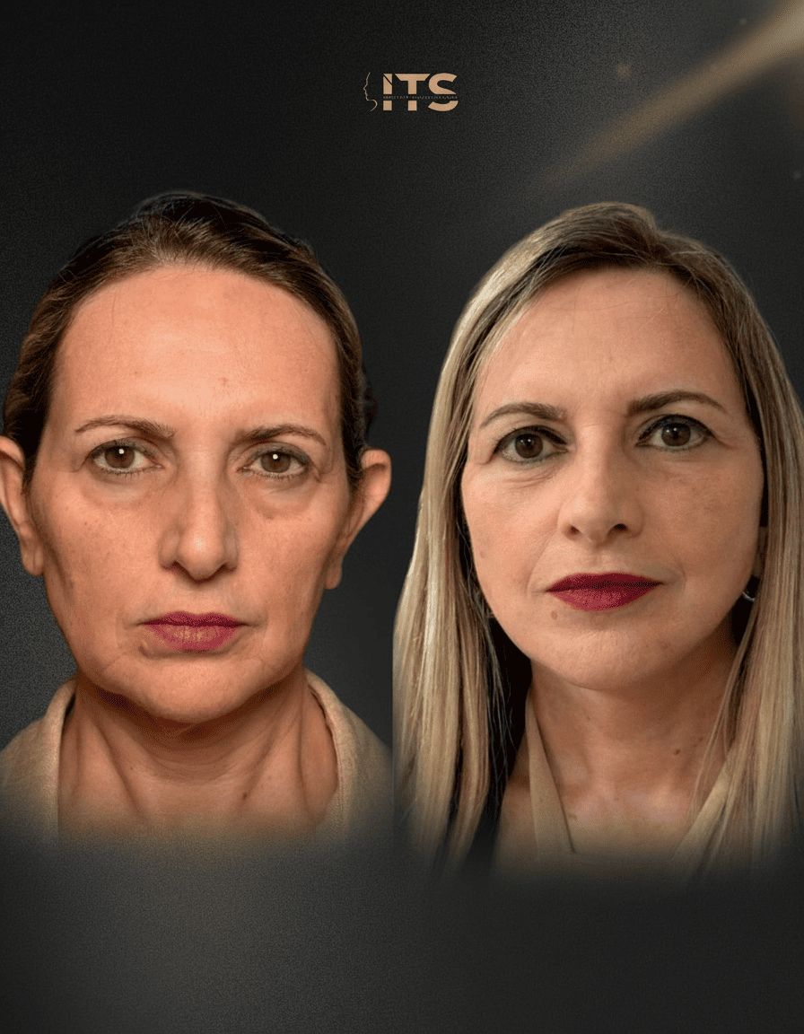 Antes e depois de lifting facial em paciente feminina, com definição do terço inferior da face