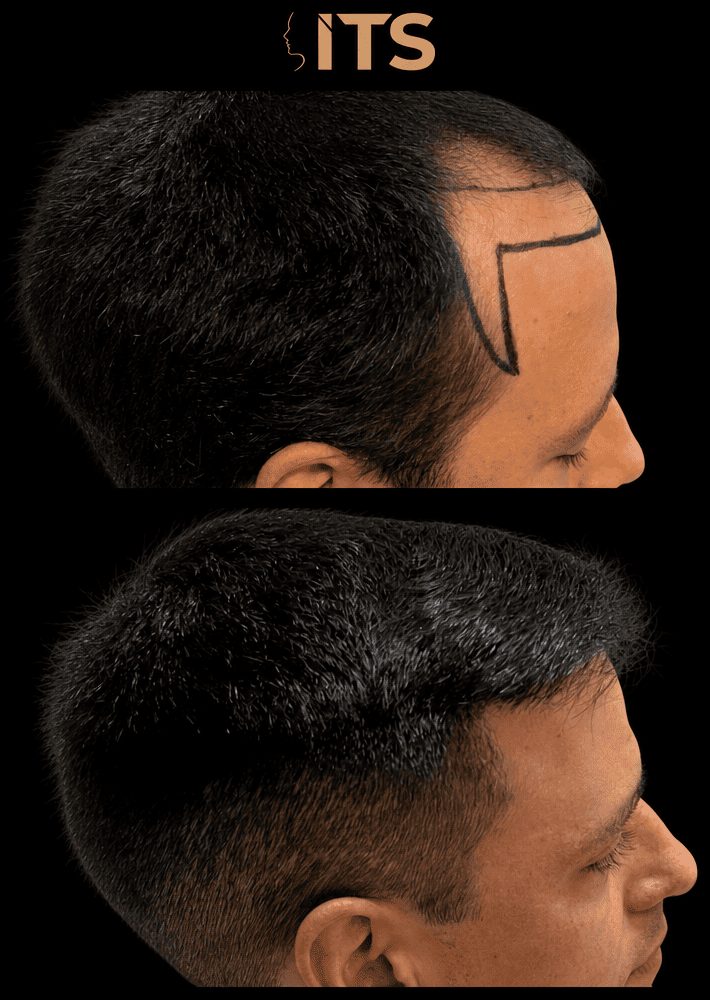 Antes e depois de transplante capilar em vista de perfil, com desenho e preenchimento da linha frontal