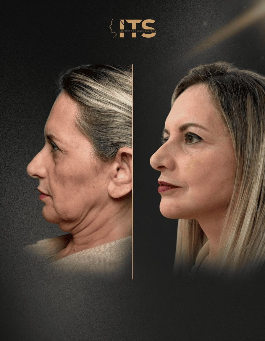 Antes e depois de lifting facial em vista de perfil, com melhora do ângulo cervicomandibular