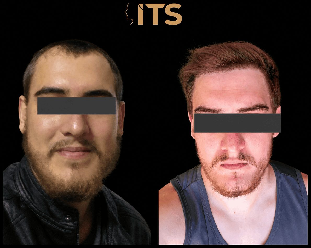 Antes e depois de transplante capilar com ganho de densidade frontal e moldura facial mais harmônica
