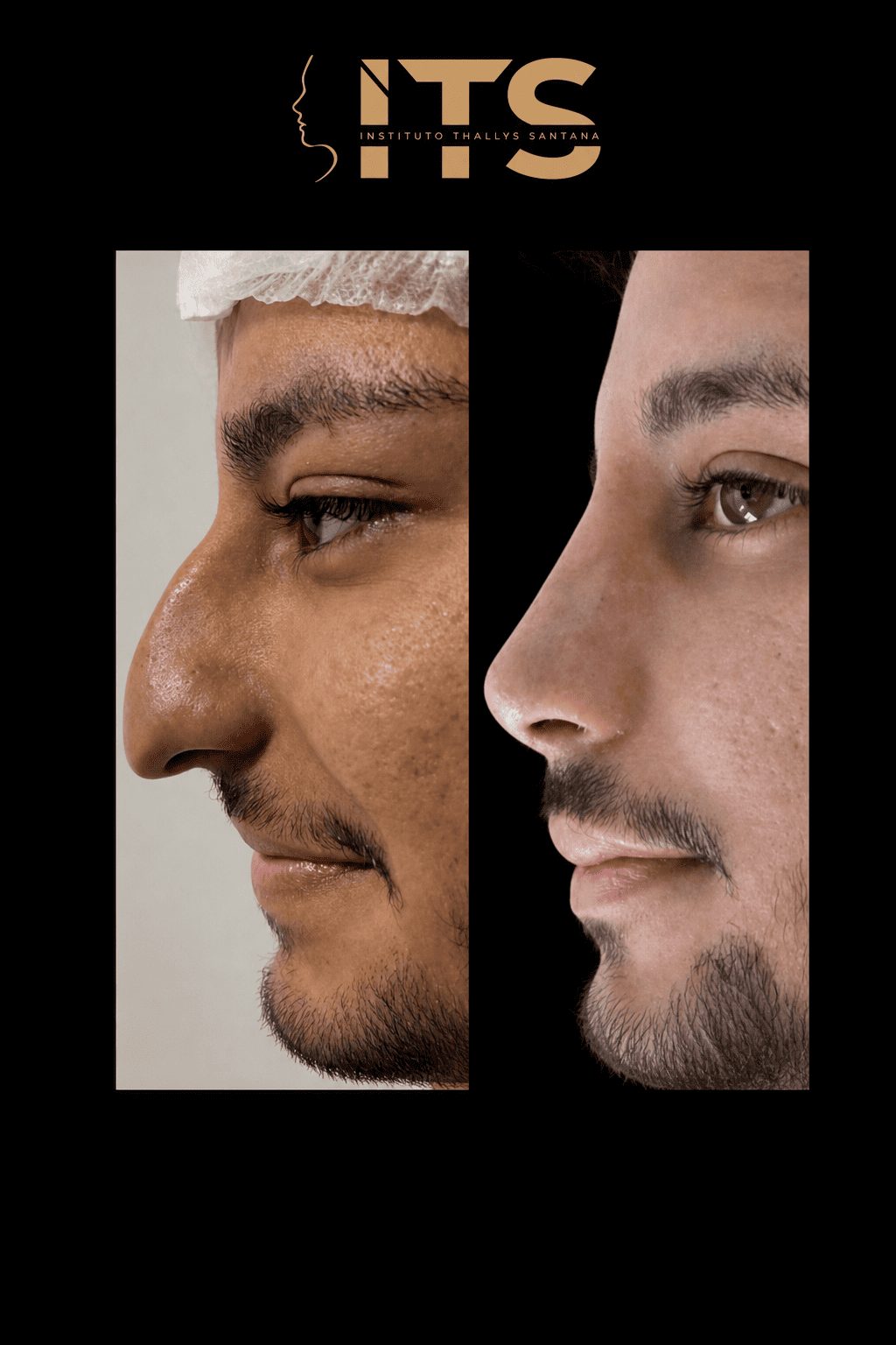 Antes e depois de rinoplastia em paciente masculino, vista de perfil, com dorso nasal mais harmônico